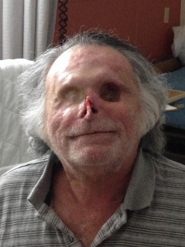 Now blind, Ron Poppo, the Miami cannibal victim, has spent much of the last year recuperating at the Jackson Memorial Perdue Medical Center, a long-term care facility in Cutler Bay. 