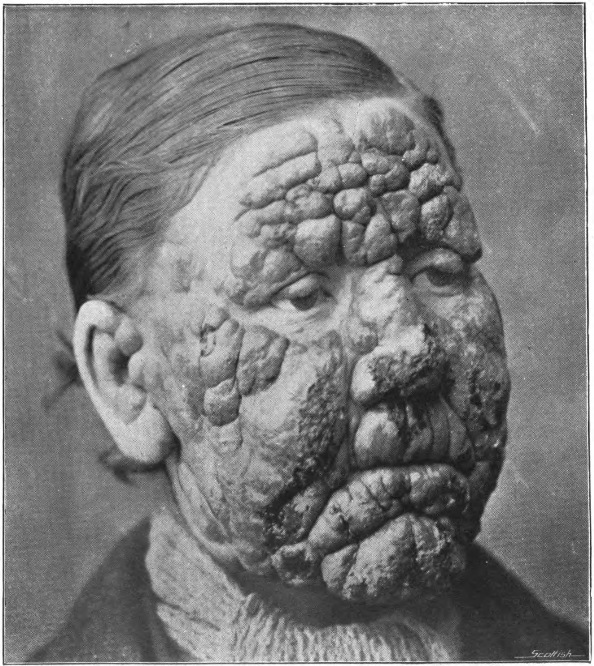 An_introduction_to_dermatology_(1905)_nodular_leprosy