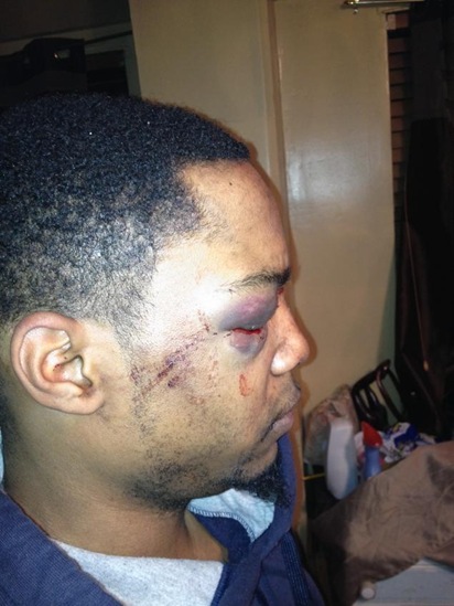 They beat him pretty bad, bruises don't show up well on Blacks. He has a broken eye socket, a torn retina, blood clotting and some cuts and bruises.