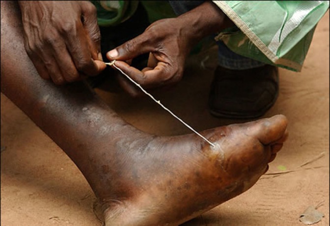 Guinea Worm