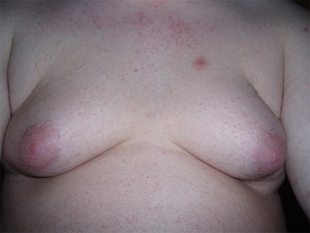 29889gynecomastia_large