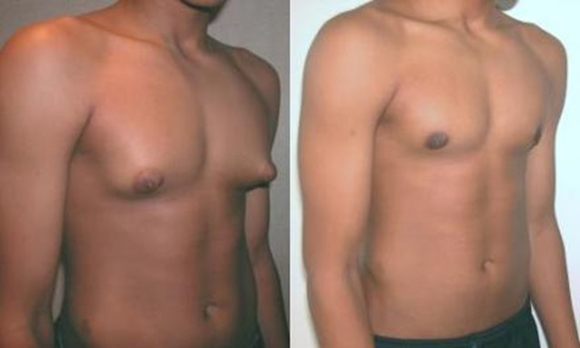 29889gynecomastia