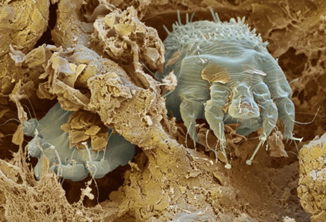 princ_rm_photo_of_scabies_mites_in_skin