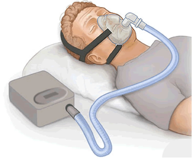 CPAP-depression-sleep-apnea