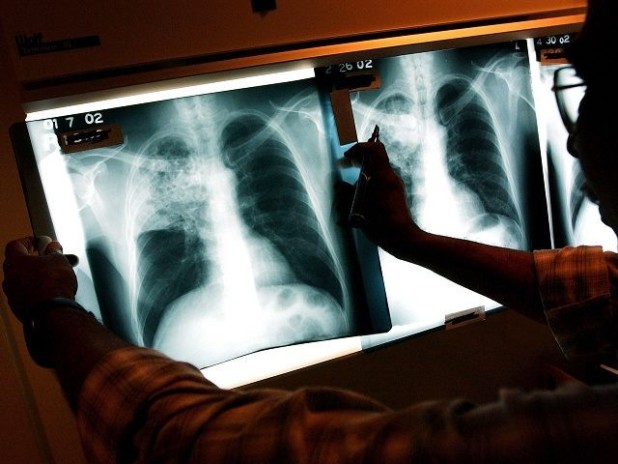 Tuberculosis-Getty-640x480