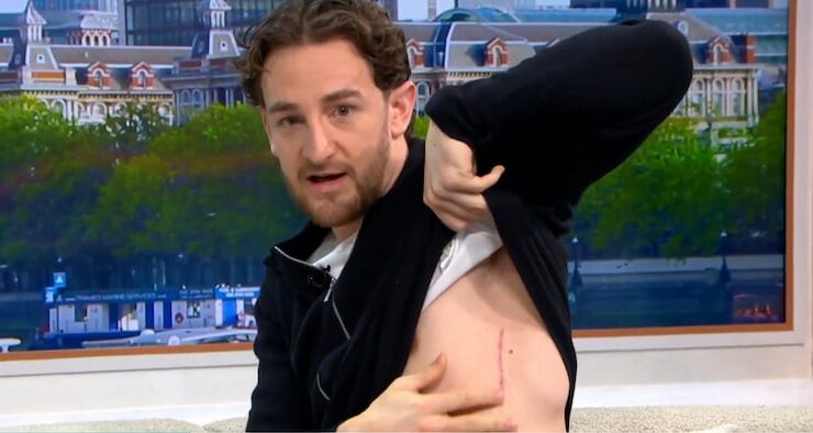 UK: 29-Year-Old Footballer Shows Off Implantable Defibrillator He Got After Last Year’s Cardiac Arrest